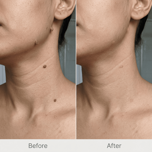 Derma Smooth Spot Corrector for Skin Tags & Moles