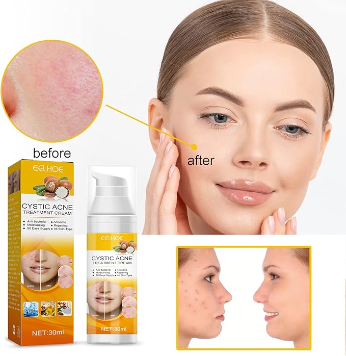EELHOE Cystic Acne Cream 30ml – Hydrating Acne Treatment