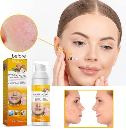 EELHOE Cystic Acne Cream 30ml – Hydrating Acne Treatment