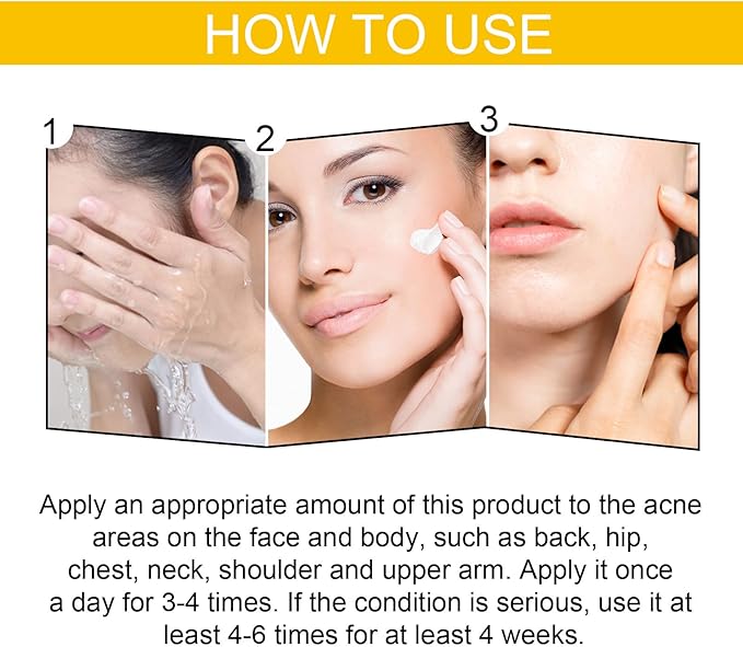 EELHOE Cystic Acne Cream 30ml – Hydrating Acne Treatment