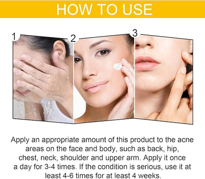 EELHOE Cystic Acne Cream 30ml – Hydrating Acne Treatment