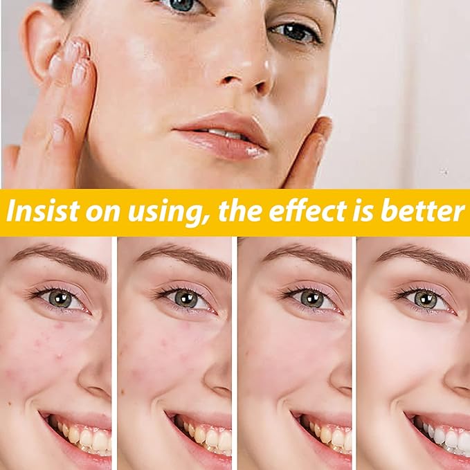 EELHOE Cystic Acne Cream 30ml – Hydrating Acne Treatment