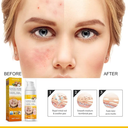EELHOE Cystic Acne Cream 30ml – Hydrating Acne Treatment