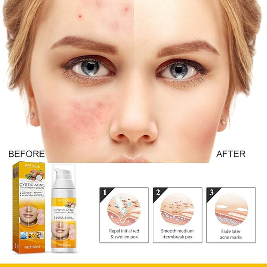 EELHOE Cystic Acne Cream 30ml – Hydrating Acne Treatment